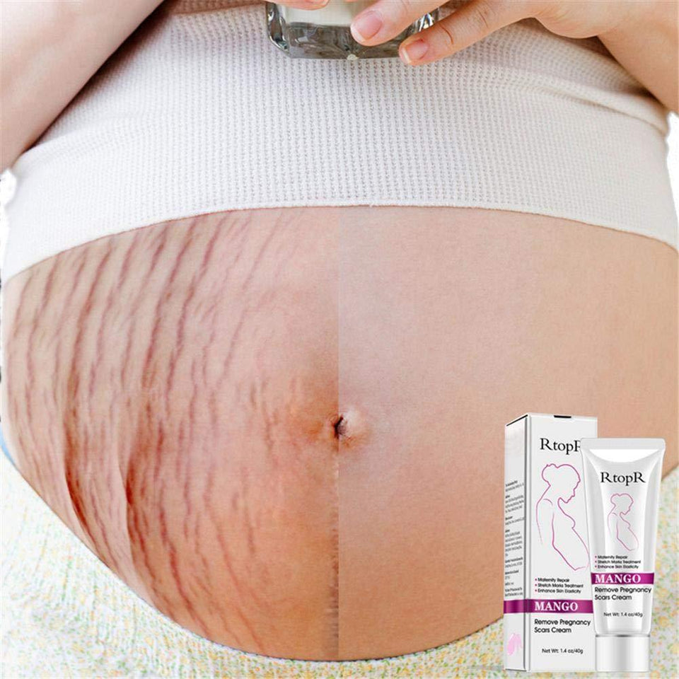 Stretch Mark Removal Cream For Pregnancy and Obesity beachysalt